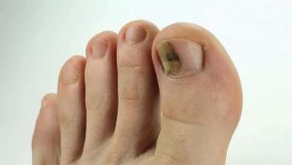 Особенности ушиба ногтя на ноге